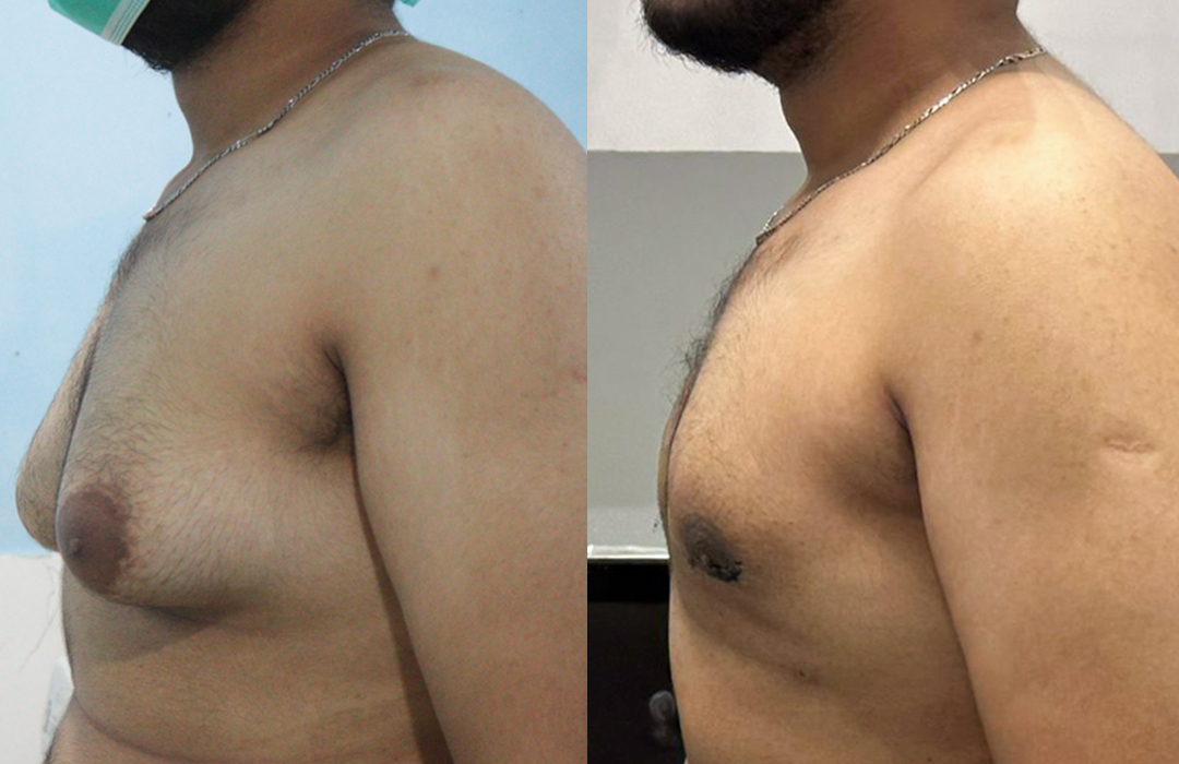 Best Gynecomastia surgeon in rawalpindi islamabad jj aesthetics