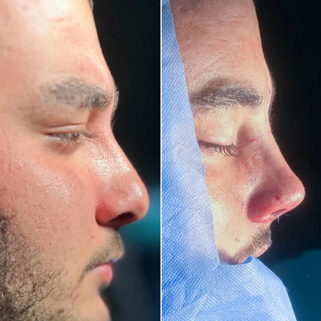 Best Rhinoplasty in islamabad JJ Aesthetics