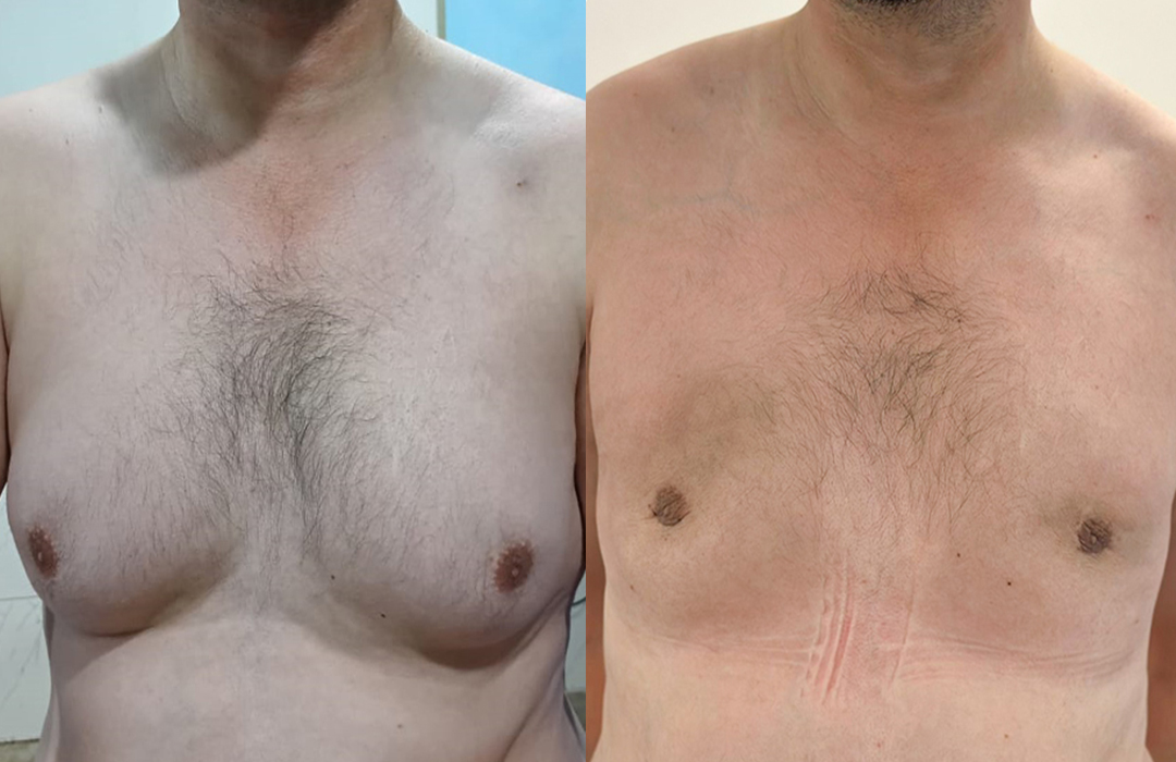 jj aesthtetics Best gynecomastia clinic in islamabad