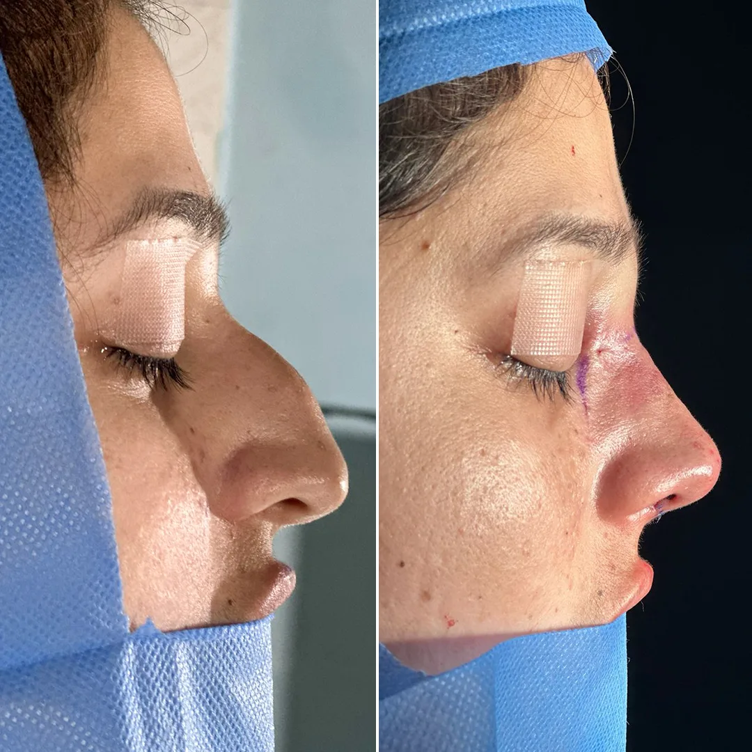 Best Rhinoplasty in islamabad