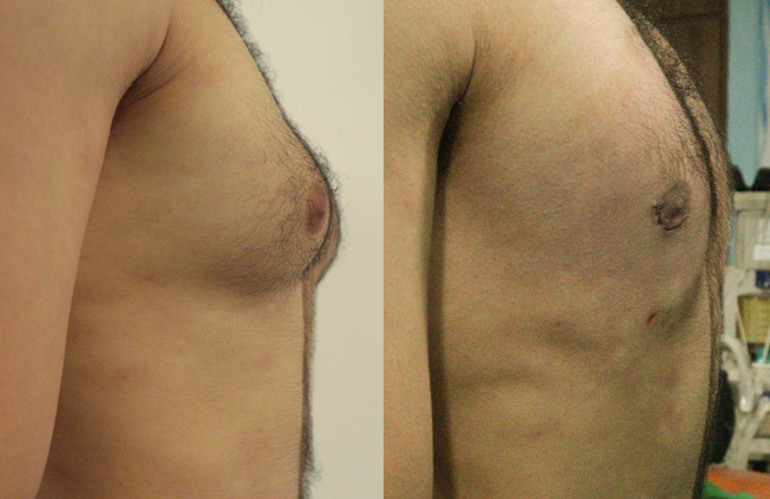 Best Gynecomastia surgeon in rawalpindi islamabad jj aesthetics