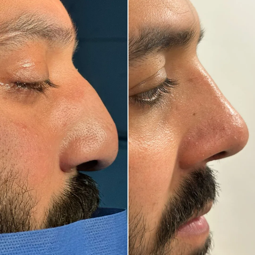 Best Rhinoplasty in islamabad JJ Aesthetics