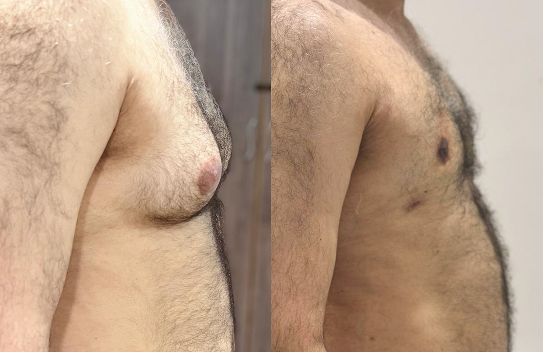 Best Gynecomastia surgeon in rawalpindi islamabad jj aesthetics