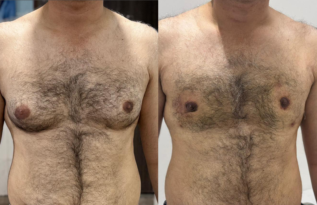 Best Gynecomastia surgeon in rawalpindi islamabad jj aesthetics