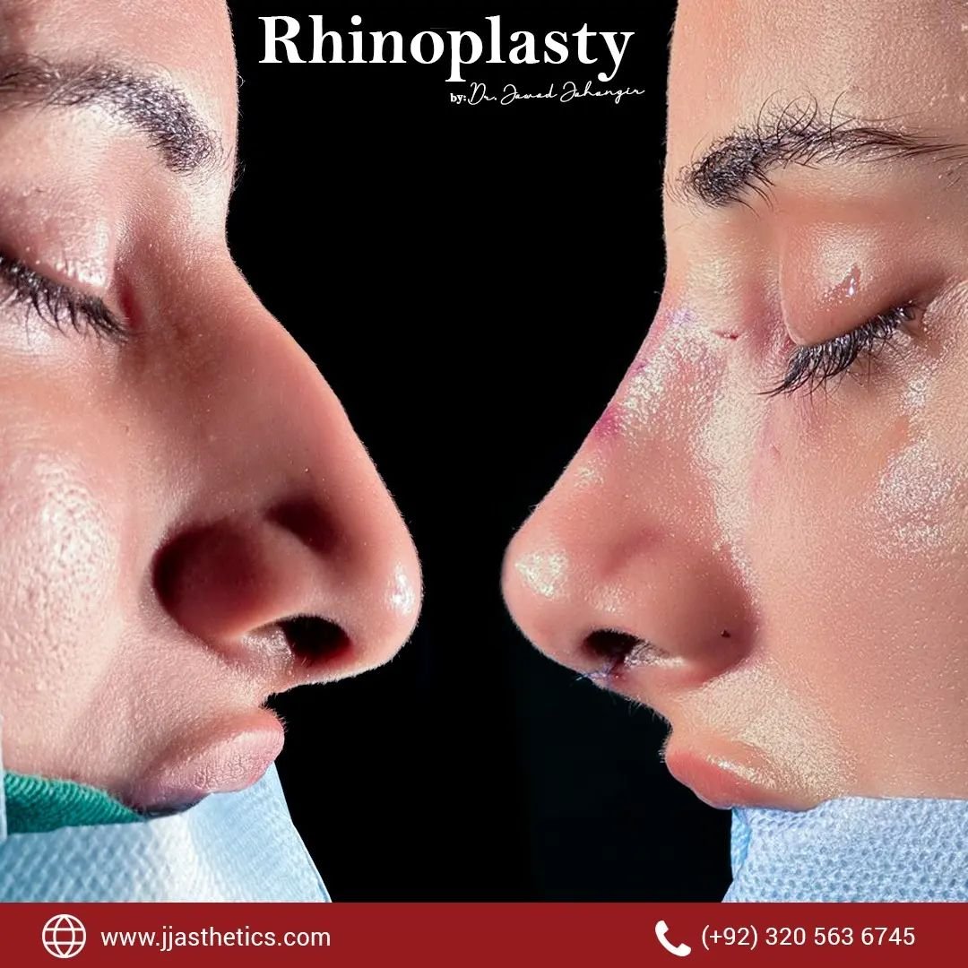 Best rhinoplasty surgeon in islamabad