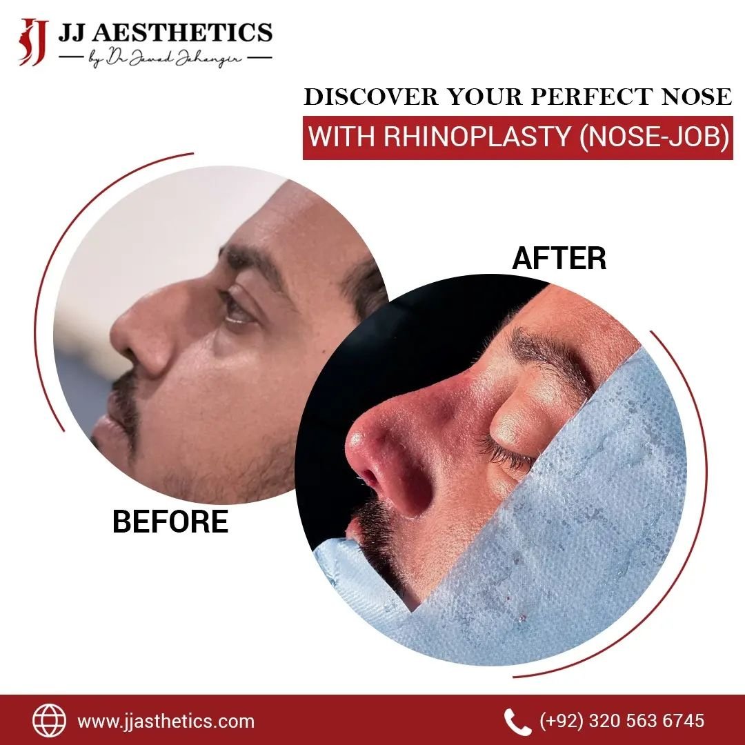 Best Rhinoplasty surgeon in islamabad