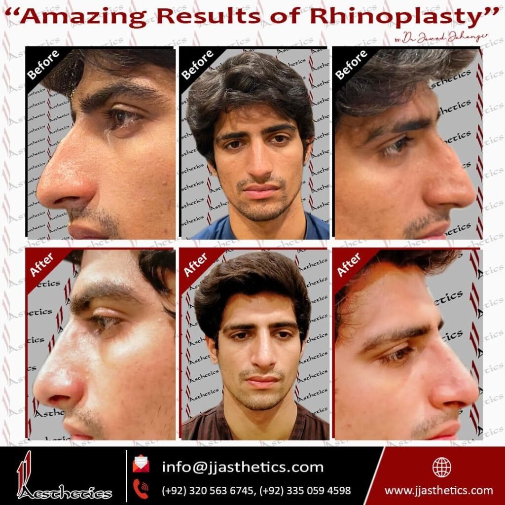 JJ_Rhinoplasty_results_(10)