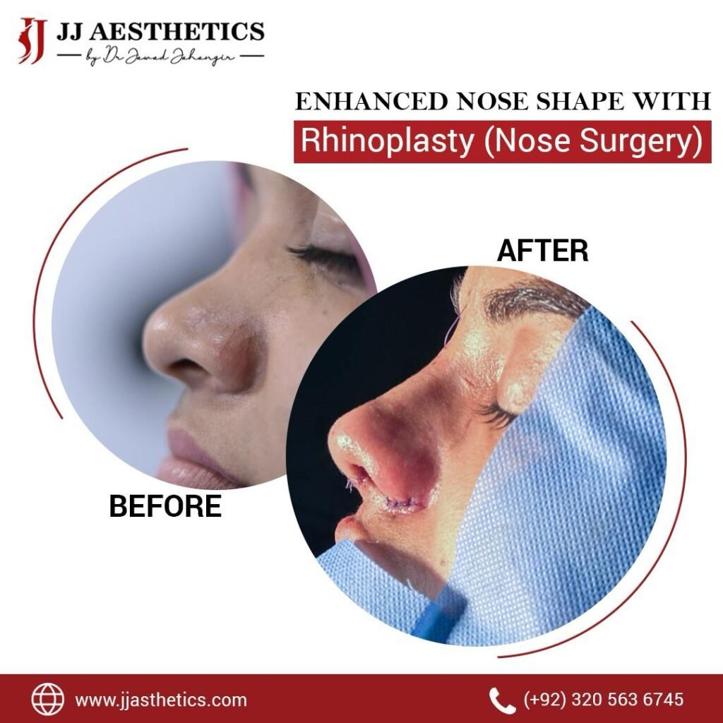 Best Rhinoplasty surgeon in islamabad jj aesthetics