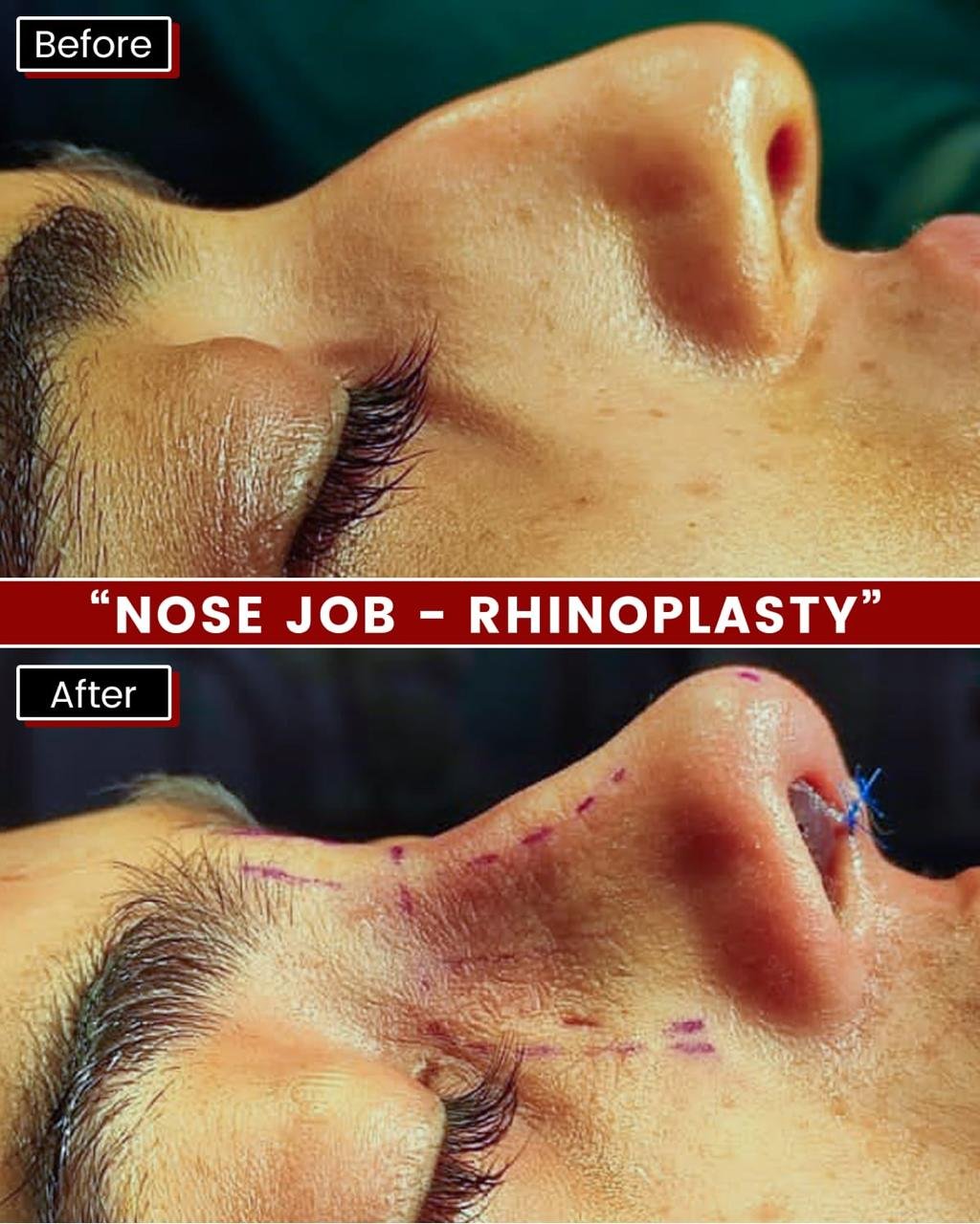 JJ_Rhinoplasty_results_(2)