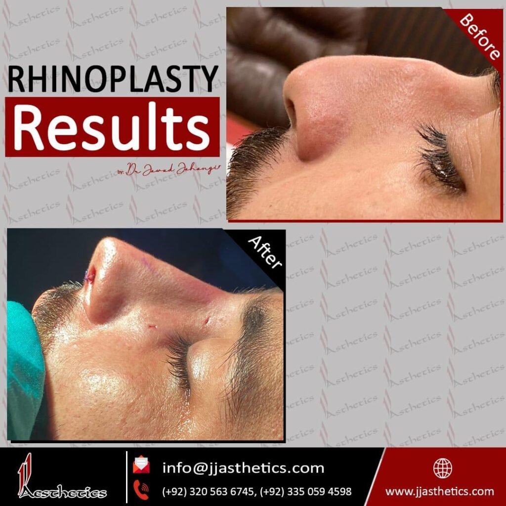 best rhinoplasty surgeon in islamabad