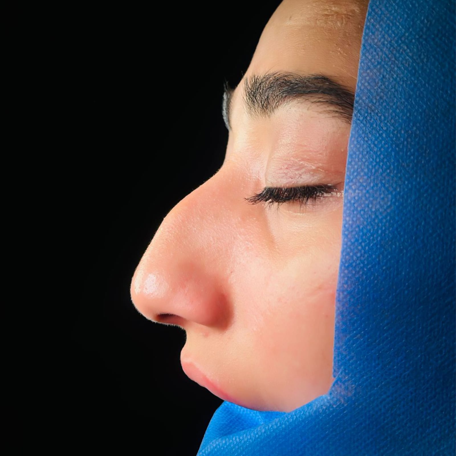 Revision Rhinoplasty Result — JJ Aesthetics Islamabad