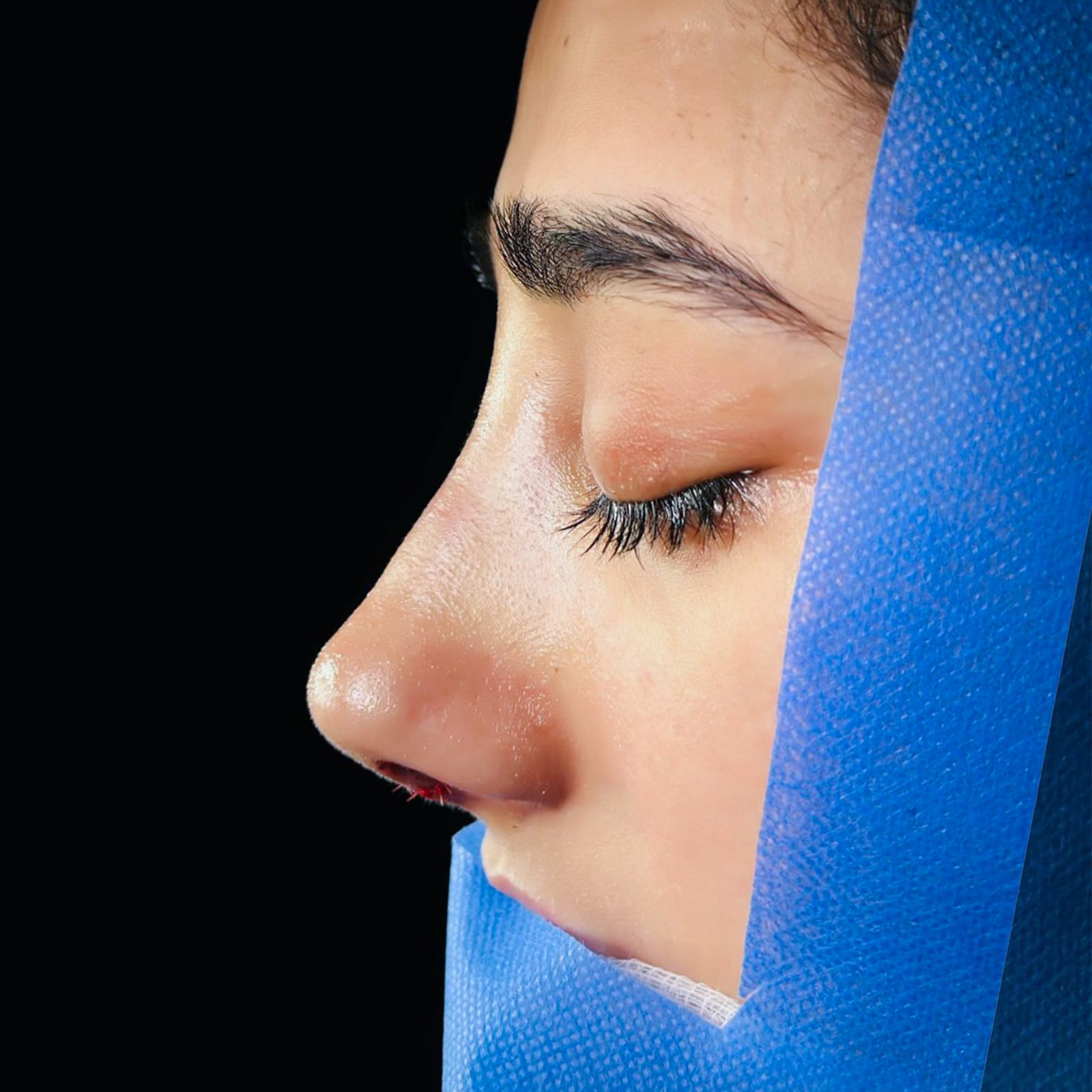 Revision Rhinoplasty Result — JJ Aesthetics Islamabad
